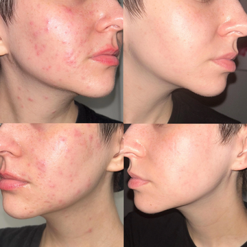 Acne & Acne Scars Removal Cream | Salicylic Acid + Niacinamide + Hyaluronic Acid + Tea Tree | Reduces Breakouts, Fades Scars & Evens Skin Tone