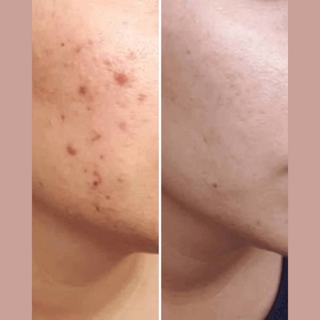 Novology Acne Deep Clearing Cleanser | Reduces Acne from Day 3 | Dermatologist Co-Created