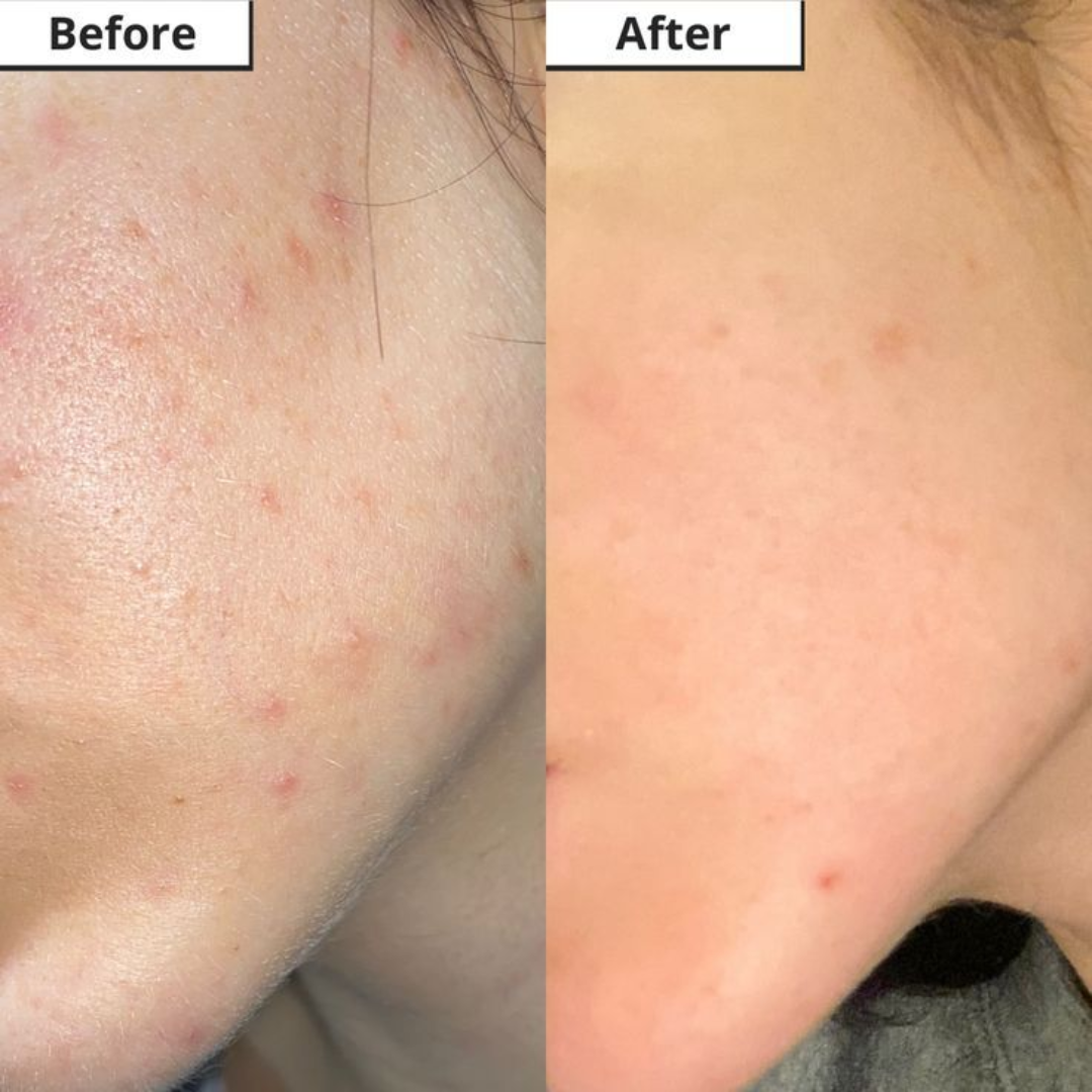 Novology Acne Deep Clearing Cleanser | Reduces Acne from Day 3 | Dermatologist Co-Created