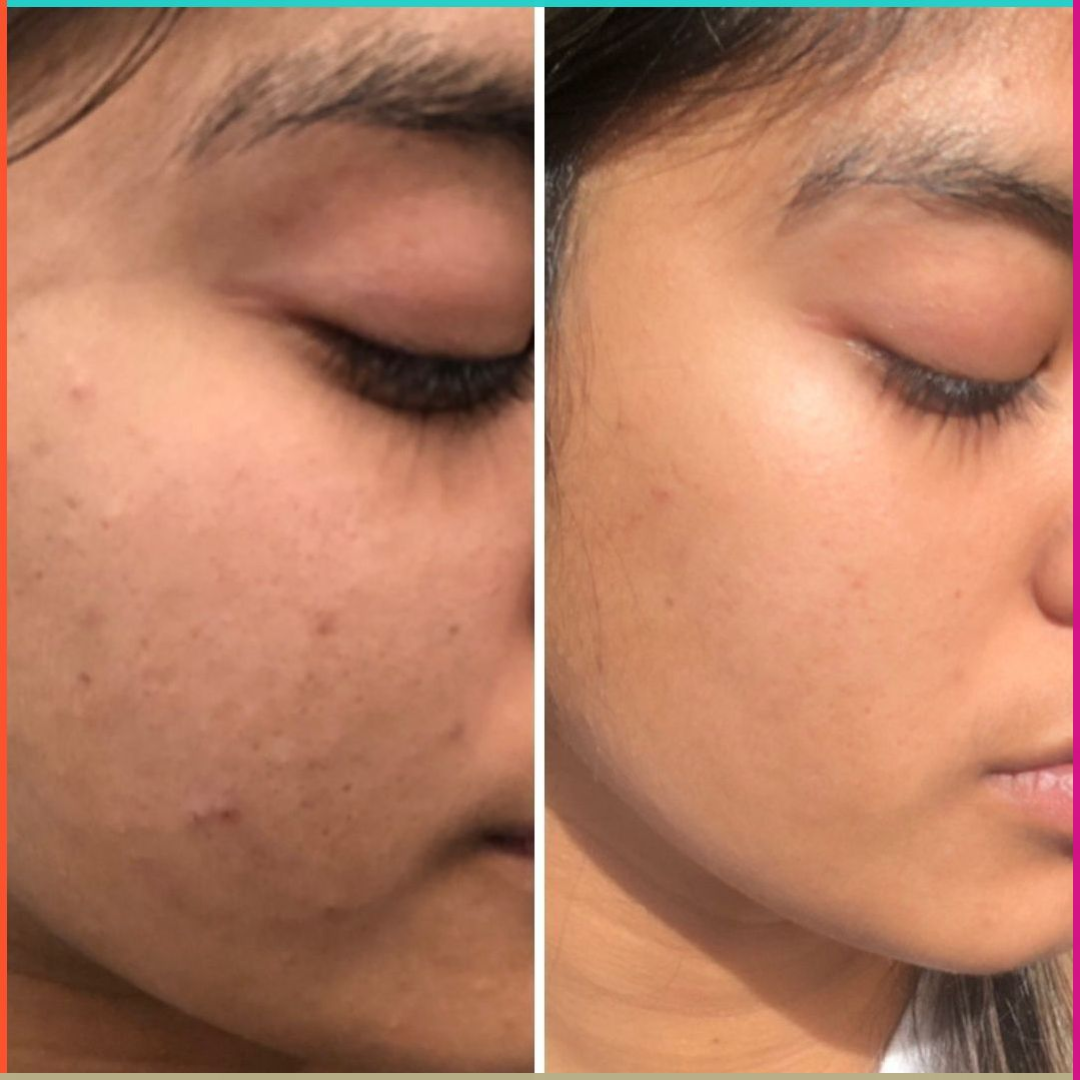 Novology Acne Deep Clearing Cleanser | Reduces Acne from Day 3 | Dermatologist Co-Created