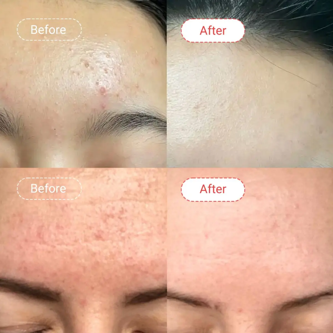 Novology Acne Deep Clearing Cleanser | Reduces Acne from Day 3 | Dermatologist Co-Created