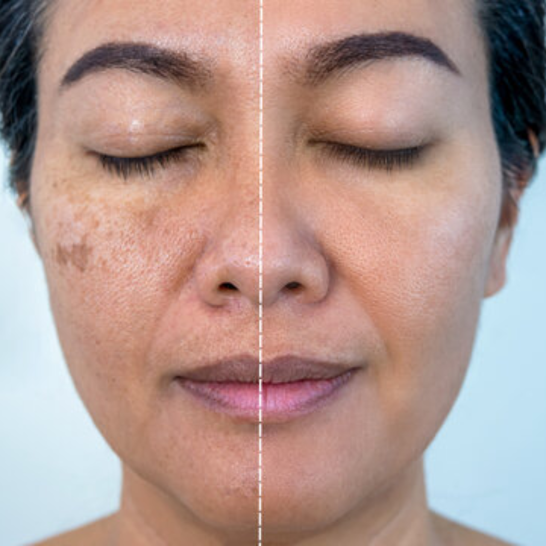 SL Naturals Skin Tea | Herbal Acne & Pigmentation Tea | 100% Natural Blend for Clear, Glowing Skin | Fights Acne, Reduces Pigmentation, Boosts Radiance