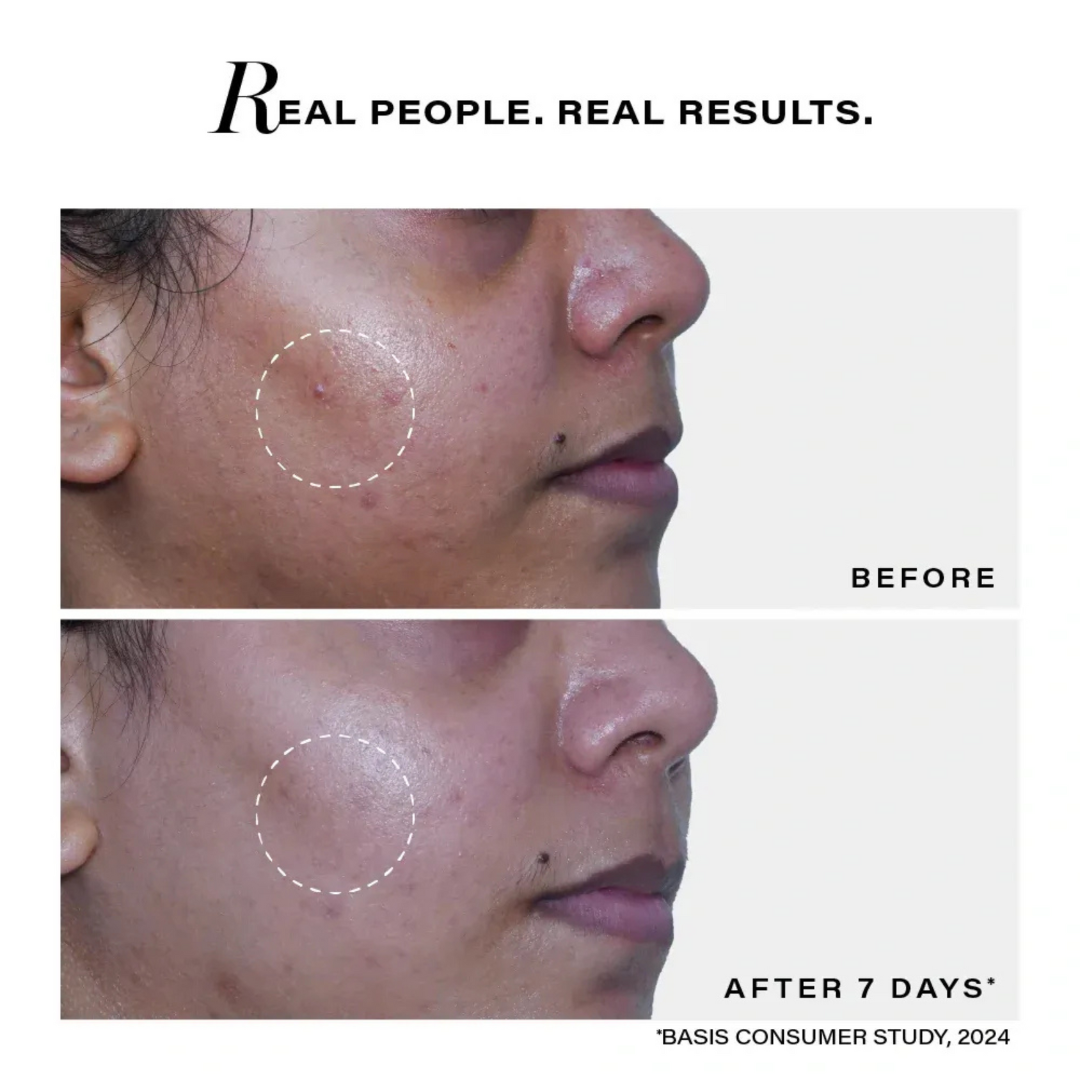Novology Acne Deep Clearing Cleanser | Reduces Acne from Day 3 | Dermatologist Co-Created