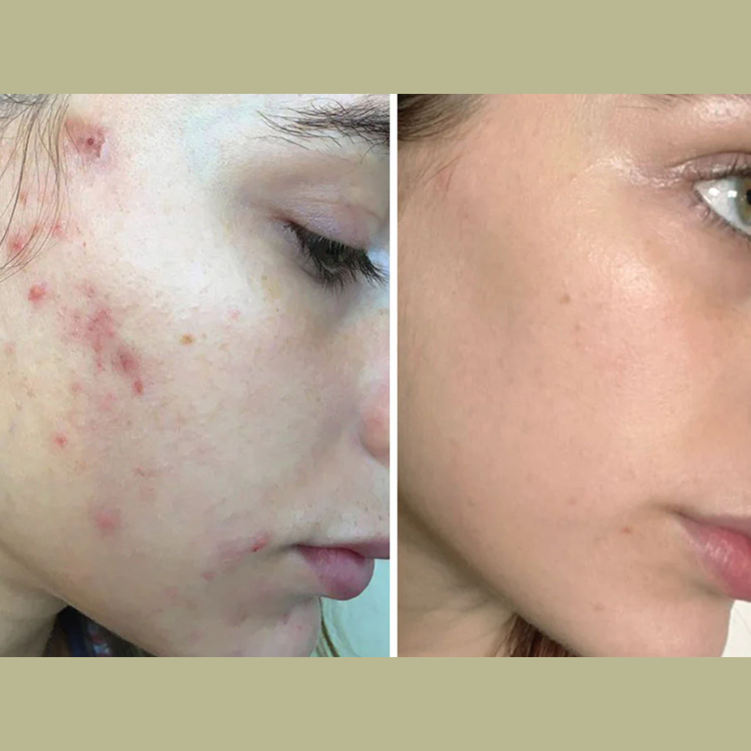 SL Naturals Skin Tea | Herbal Acne & Pigmentation Tea | 100% Natural Blend for Clear, Glowing Skin | Fights Acne, Reduces Pigmentation, Boosts Radiance