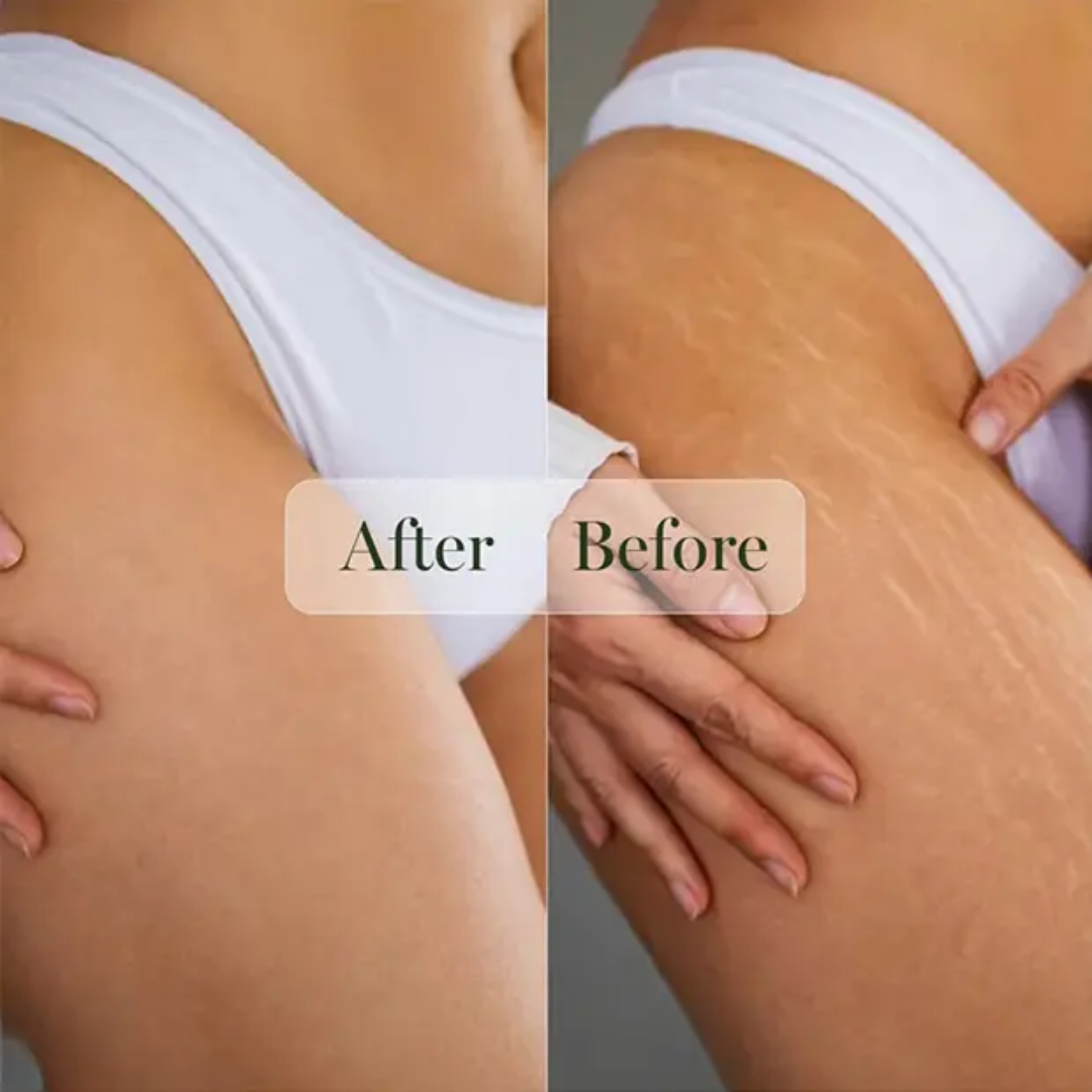 Hakim Suleman's Stretch Mark Cream | Premium Ayurvedic Formula with Almond, Olive & Sandalwood Oil | Visibly Fades Stretch Marks on Belly, Thighs & More