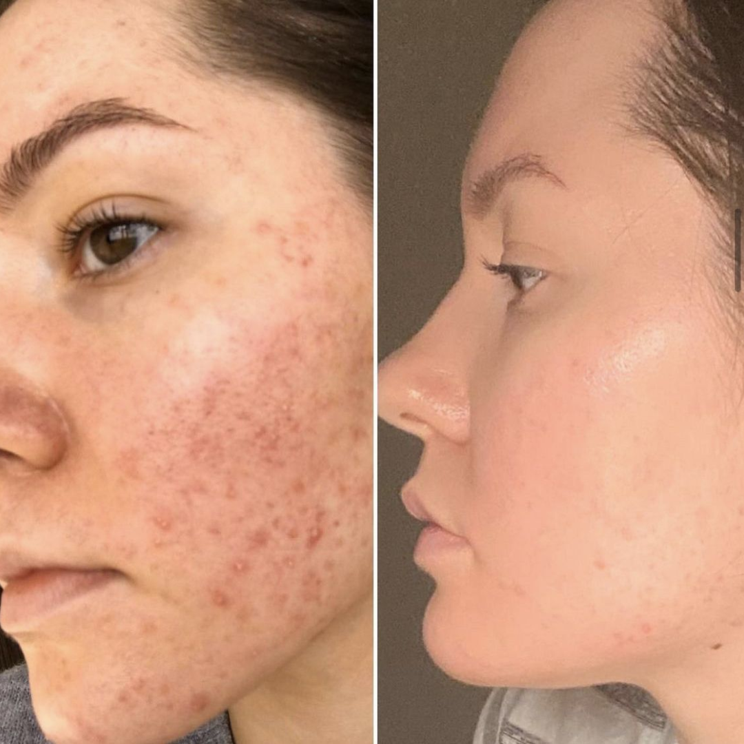 SL Naturals Skin Tea | Herbal Acne & Pigmentation Tea | 100% Natural Blend for Clear, Glowing Skin | Fights Acne, Reduces Pigmentation, Boosts Radiance